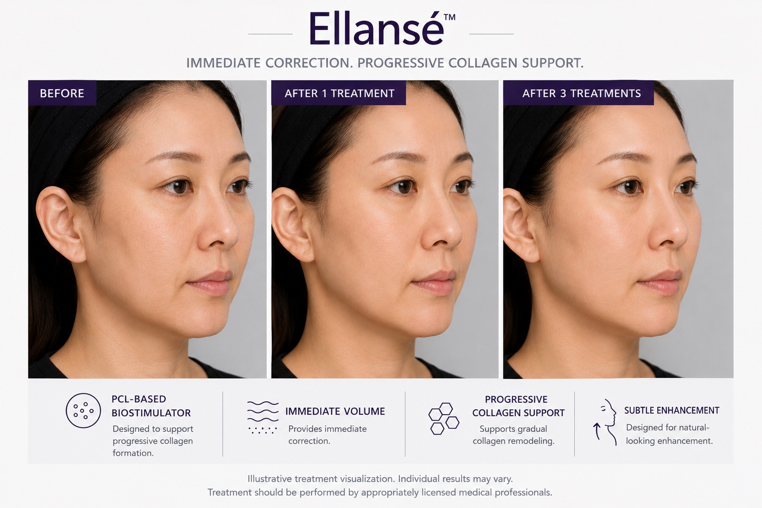Before and After Ellansé Dermal Filler