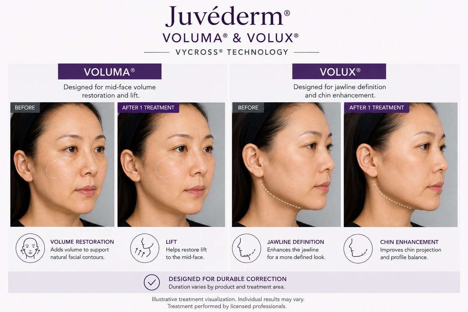 Before and After Juvéderm filler