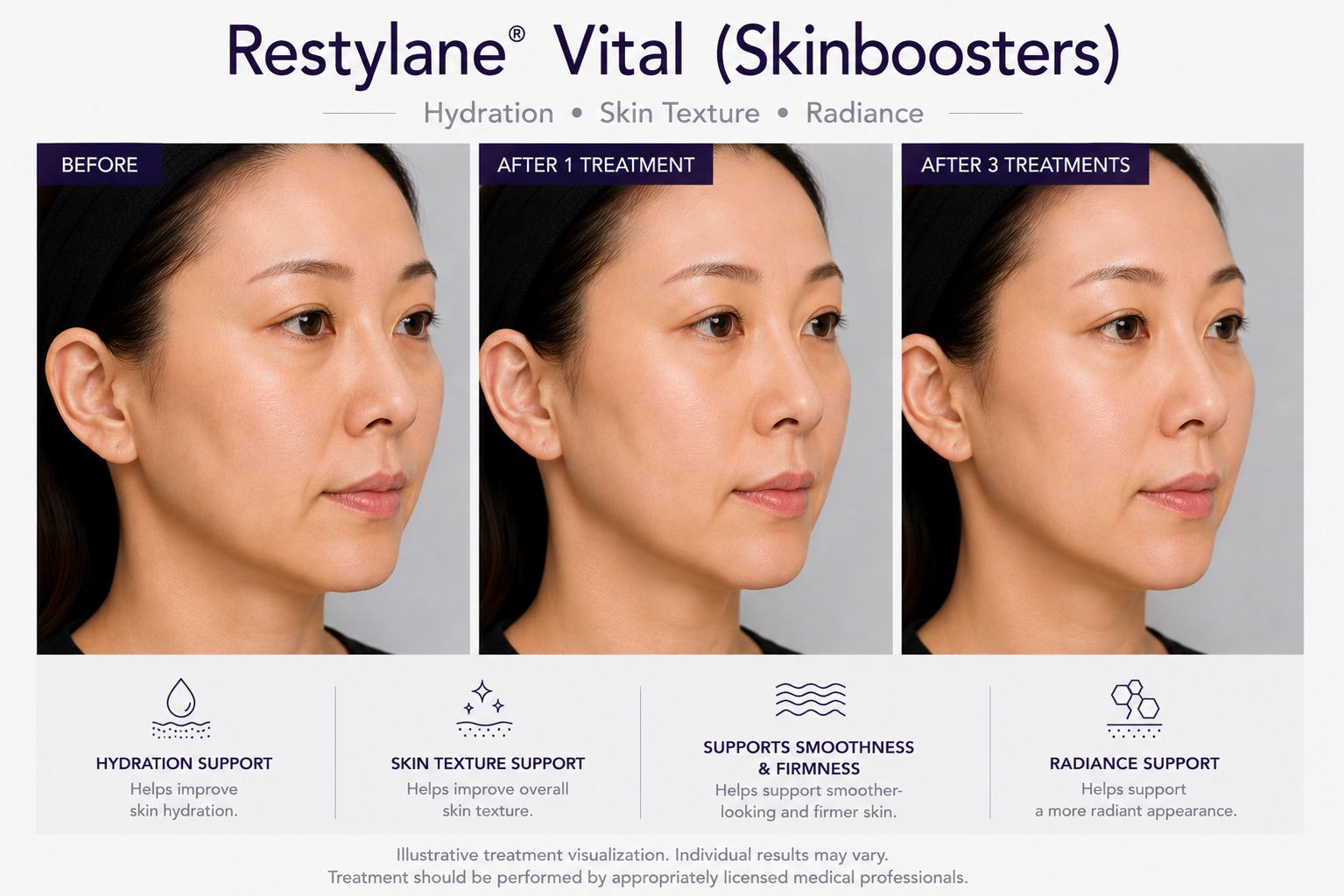 Before and After Restylane Skinboosters