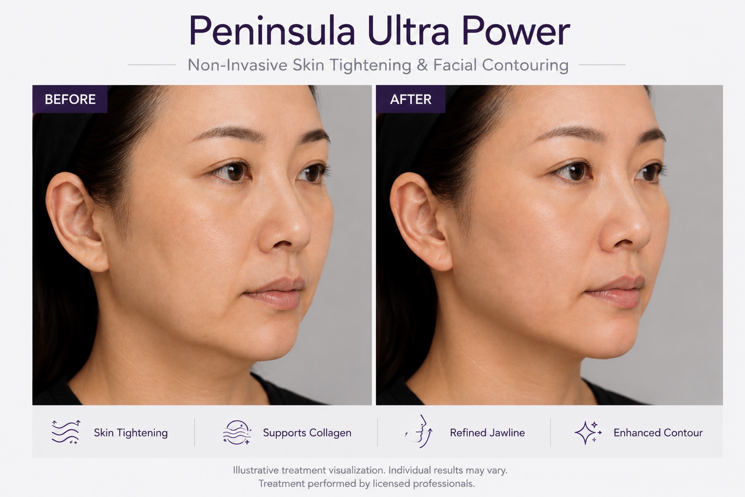 Before and After Peninsula Ultra Power