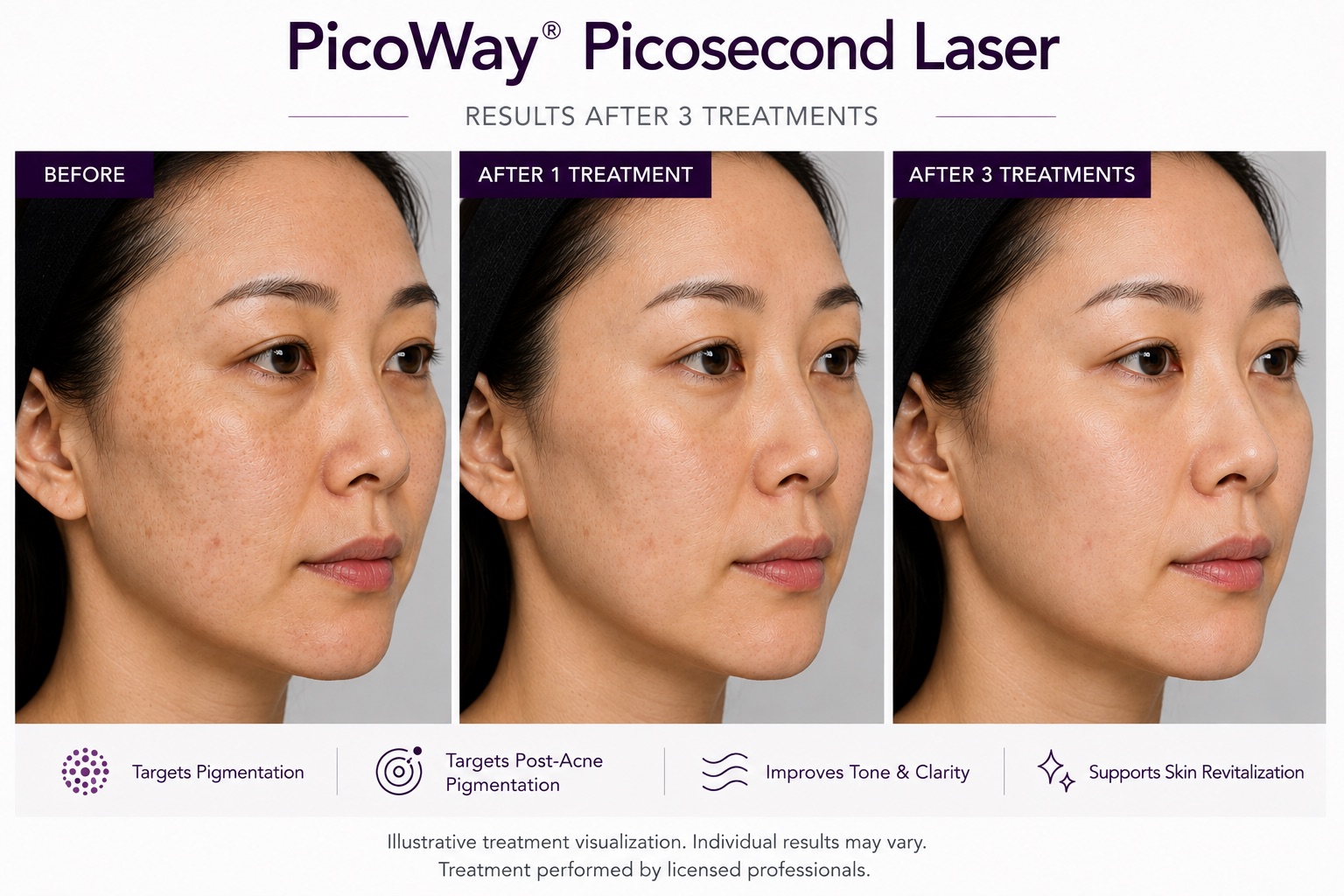 Before and After PicoWay Picosecond Laser
